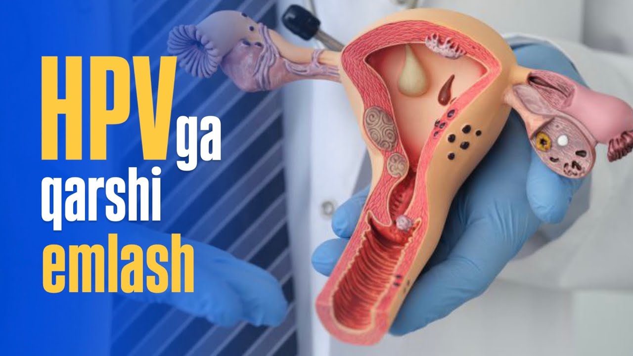 Bachadon boʻyni saratonining oldini olishda HPVga qarshi emlash eng samarali usul