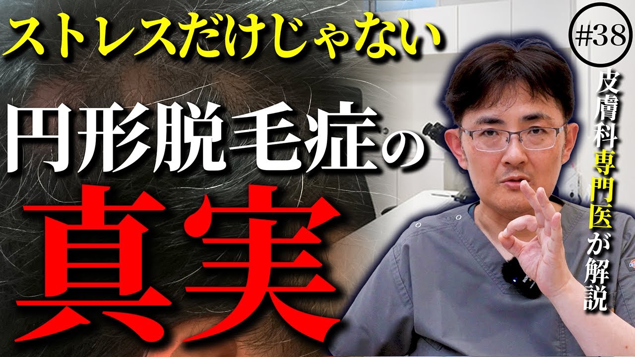 円形脱毛症のメカニズムを解説！原因はストレスだけじゃない？