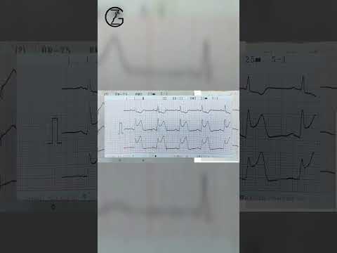 نوار قلب در سکته قلبی