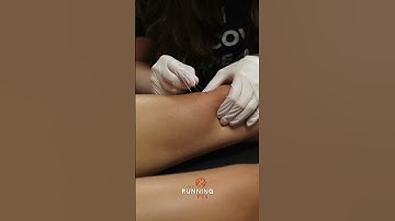 Dry Needling Tight Quads After Running
