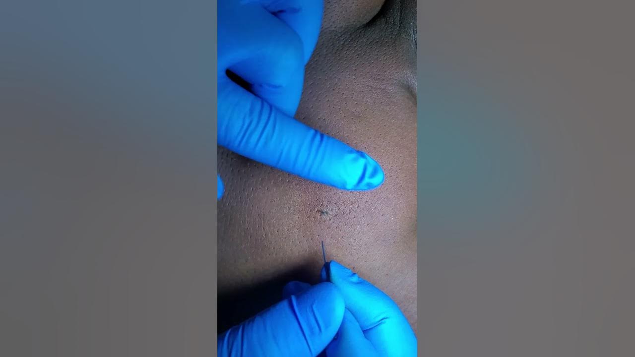 HomeAmatuer Blackhead Squeeze YouTube