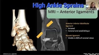 High Ankle Sprains