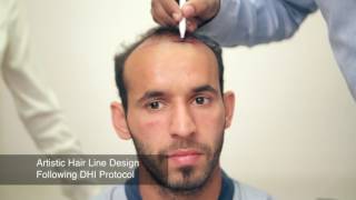 Hair Transplant in Delhi- Hair Transplant Session of Ramandeep Singh, Indian Hockey Player at DHI