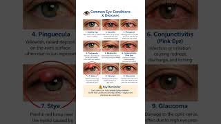 Common Eye Conditions &amp; Diseases | Protect Your Vision #eyes #eyediseases
