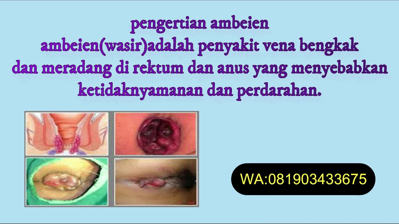 cara mengobati wasir ampuh