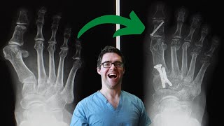 6 Best Bunion Surgery Pros & Cons [Get the FASTEST Recovery Time]