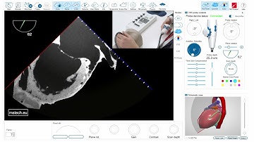 Optimal imaging of the left atrial appendage (LAA)