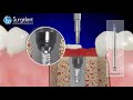 Surgident Fixture & Screw Remover Kit (SD-FSR) - 2