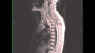 Spinal Cord Ependymoma