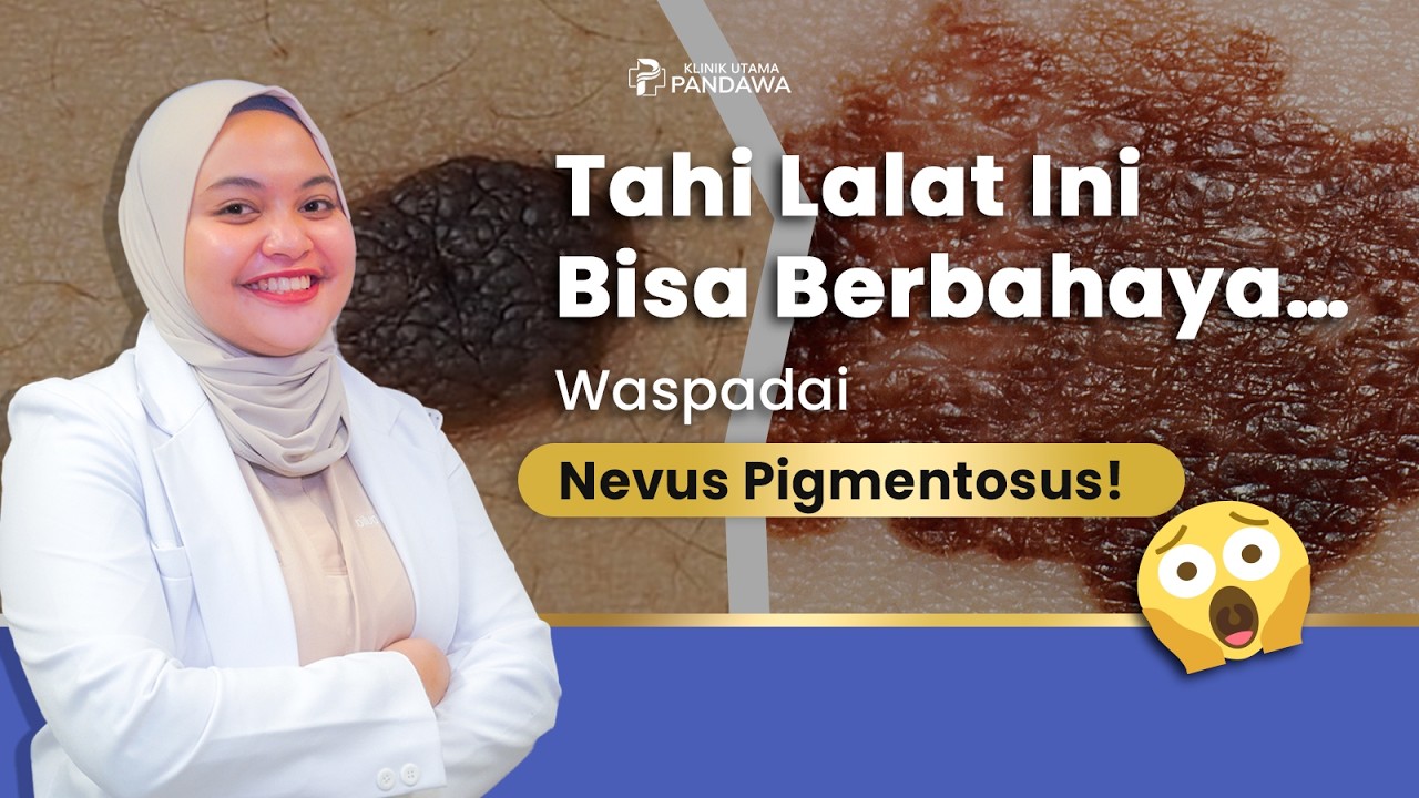 Tahi Lalat Membesar? Bisa Jadi Nevus Pigmentosus!
