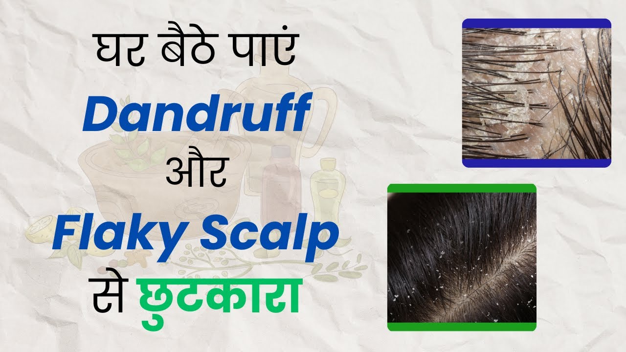 Hair Care Tips 3 Easy DIY Hair Packs To Get Rid of Dandruff and Flaky
