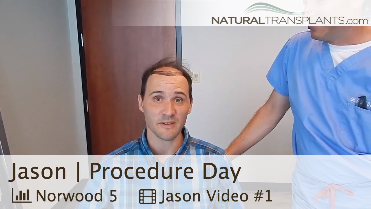 fue hair transplant month by month Hairline Surgery Men | Hairline Surgery with Dr. Harold Siegel (Jason)