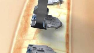 Sternal Talon® – Long term removal after bony healing