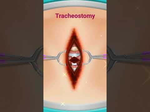 tracheostomy procedure/ #doctor|respiratory