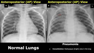 Chest X-Ray Lungs Normal Vs Pneumonia Image Appearances Comparison | Consolidation, Air Bronchograms