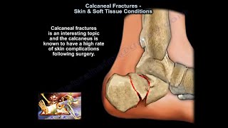 Calcaneal Fractures Skin & Soft Tissue Condition - Everything You Need To Know - Dr. Nabil Ebraheim screenshot 2
