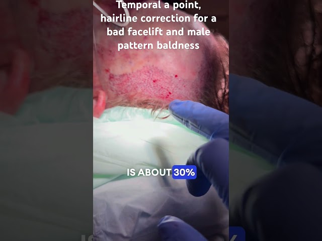 Temporal a point, hairline correction for a bad facelift and male pattern baldness