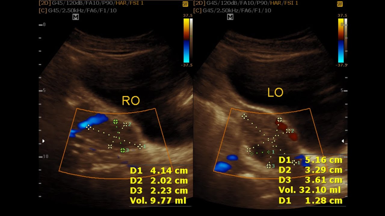 Case 1 Normal Uterus And Ovary And Case 2 Pco Uterus Ovaries Ovarian Cyst
