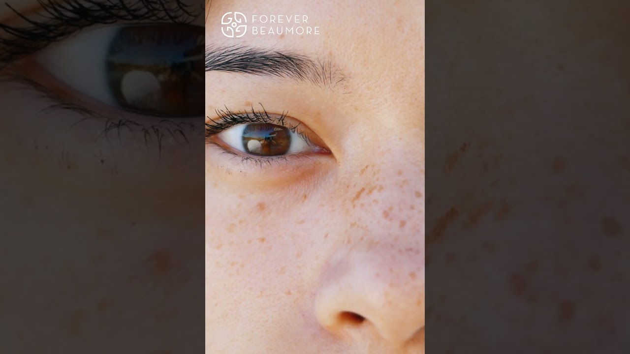 NÁM TÀN NHANG TẠI SAO TRỊ MÃI KHÔNG HẾT