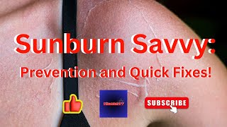 Sunburn Savvy: Prevention and Quick Fixes!