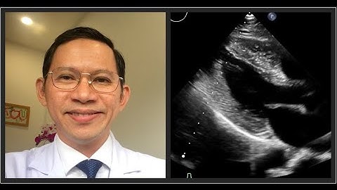 Túm lại ca bệnh cơ tim phì đại khu trú vùng mỏm