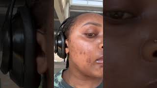 Curology day 9 shortsfeed skin acne acnetreatment hyperpigmentation