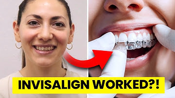 Does Invisalign Really Work?... Orthodontist Explains