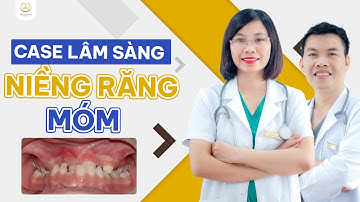 Niềng Răng Móm - Phân Tích Case Lâm Sàng | Bác sĩ Trung Long Biên