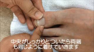 巻き爪治療の施術風景
