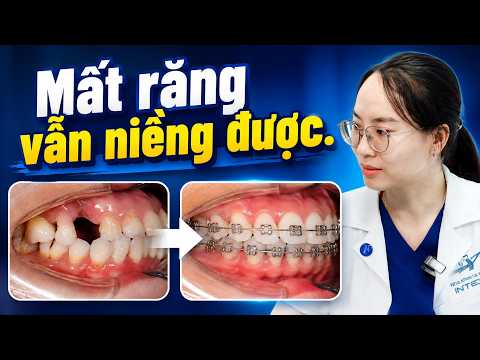 Mất Răng Có Niềng Răng Được Không? U40 Hết Hô, Chen Chúc Không Cần Cắm Implant, Minivis
