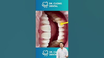 Điều trị veneer thẩm mỹ sẽ như thế nào? |Dr Cường Official