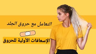 الحروق وعلاجها بالمنزل والتعامل معها بكل بساطة