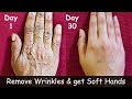 Remove Wrinkles from Hands | Make your Hands Look 10 Years Younger - Get Baby Soft Hands - Dry Hands