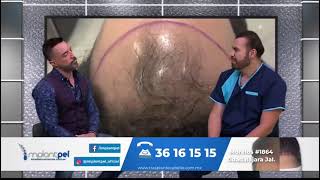 Implantpel en Hechos TvAzteca