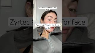 Before and after Zyrtec & Pepcid
