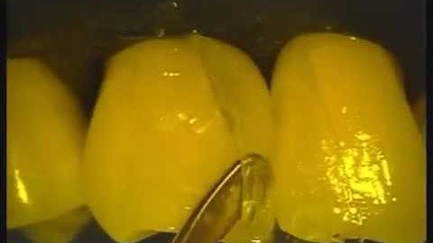 Black Triangle - Bioclear