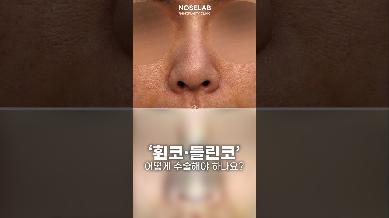 강한 인상에서 부드러운 인상으로, 코성형에서 콧대 시작점과 비순각이 중요한 이유