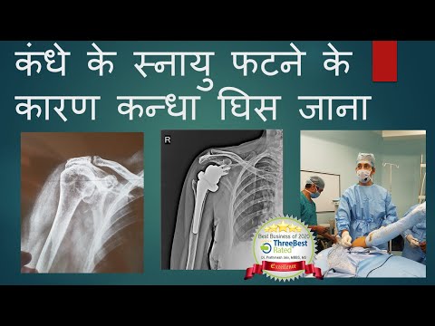 कंधे की स्नायु फटने के कारण कन्धा घिस जाना। रिवर्स शोल्डर रिप्लेसमेंट.Rotator Cuff Tear Arthropathy