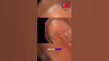 Endoscopy Rubber Band Technique: Final Traction & Improved Resection! #shorts