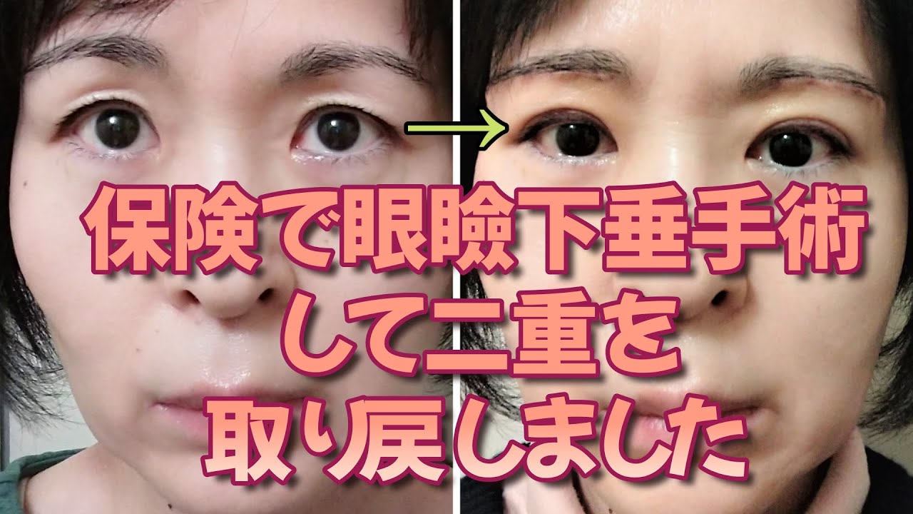 健康保険で眼瞼下垂手術(眉毛下皮膚切除術)をしました