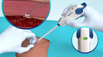 MANTA® Vascular Closure Device Deployment