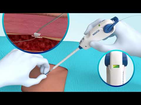 MANTA® Vascular Closure Device Deployment