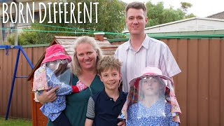 We Are Allergic To Sunlight | BORN DIFFERENT