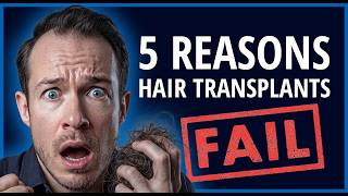 Why Hair Transplants Fail - 5 Reasons And How To Avoid Them