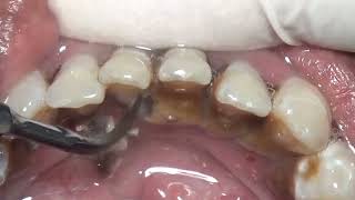 Relax Scaling Tartar | Karang Gigi | Dentist | Dokter Gigi Ruliyanto