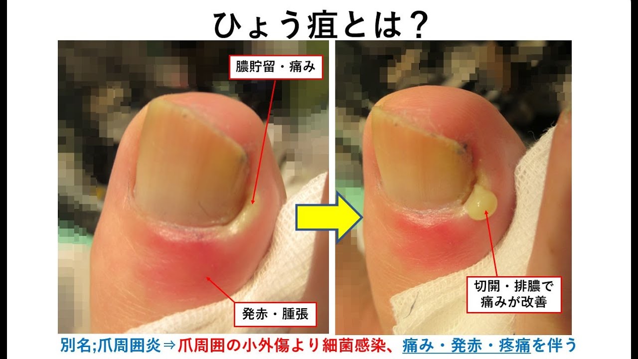 ひょう疽 爪周囲炎 大田区大森の大木皮膚科 指の化膿でお困りなら