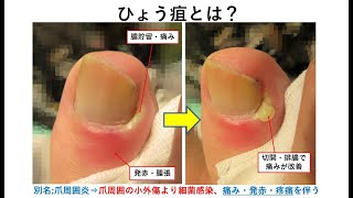 ひょう疽 爪周囲炎 大田区大森の大木皮膚科 指の化膿でお困りなら ひょう疽 爪周囲炎 大田区大森の大木皮膚科 指の化膿でお困りなら