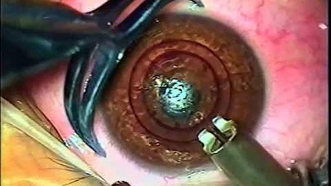 Como é o repouso após cirurgia do anel de Ferrara?