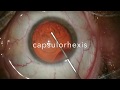Chirurgie cataracte  phacoemulsification en chop