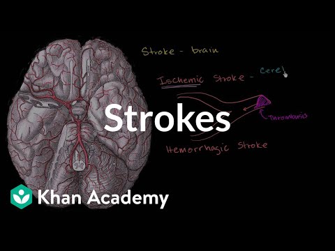 Strokes | Miscellaneous | Heatlh & Medicine | Khan Academy